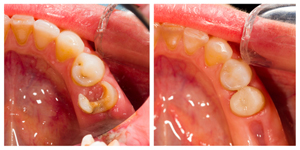 Dental Bonding Procedure