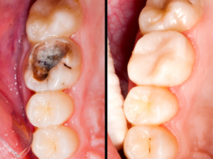Tooth Colored Fillings