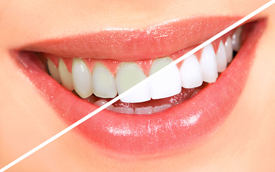 Toronto Teeth Whitening