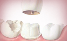 Dental Crown