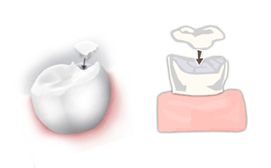 Dental Inlays & Onlays