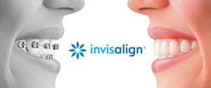 Invisalign Braces
