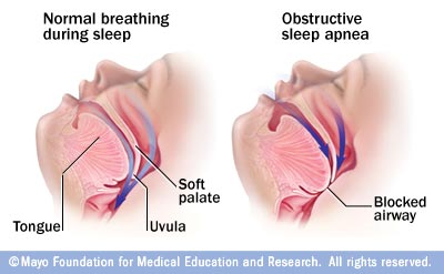 Solution For Snoring