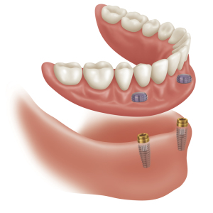 Denture Alternatives Denture Alternative