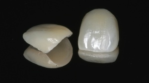 Porcelain Veneer Services